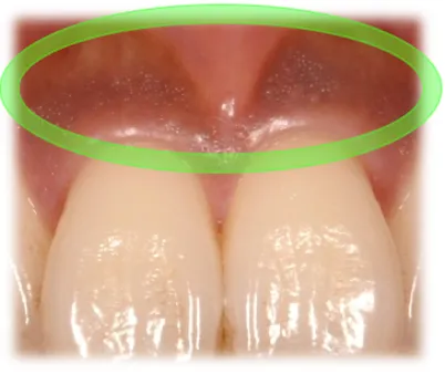 ⑤メラニン色素