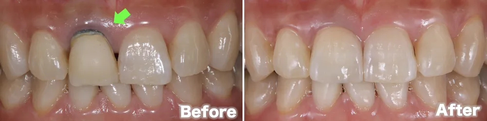 ①根が黒いbefore after