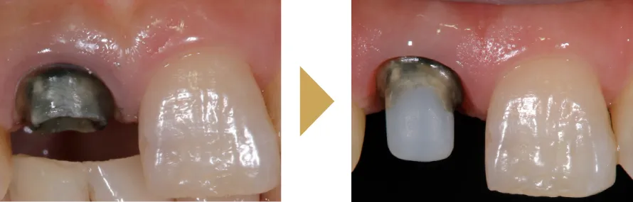 根が黒い治療法