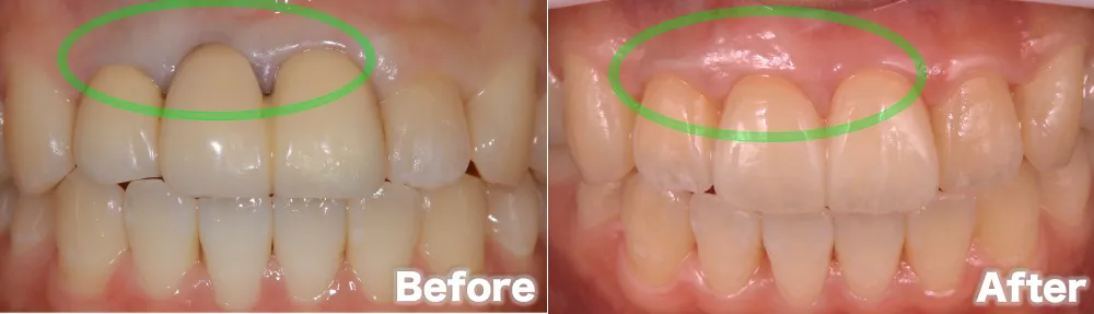 歯周病before after