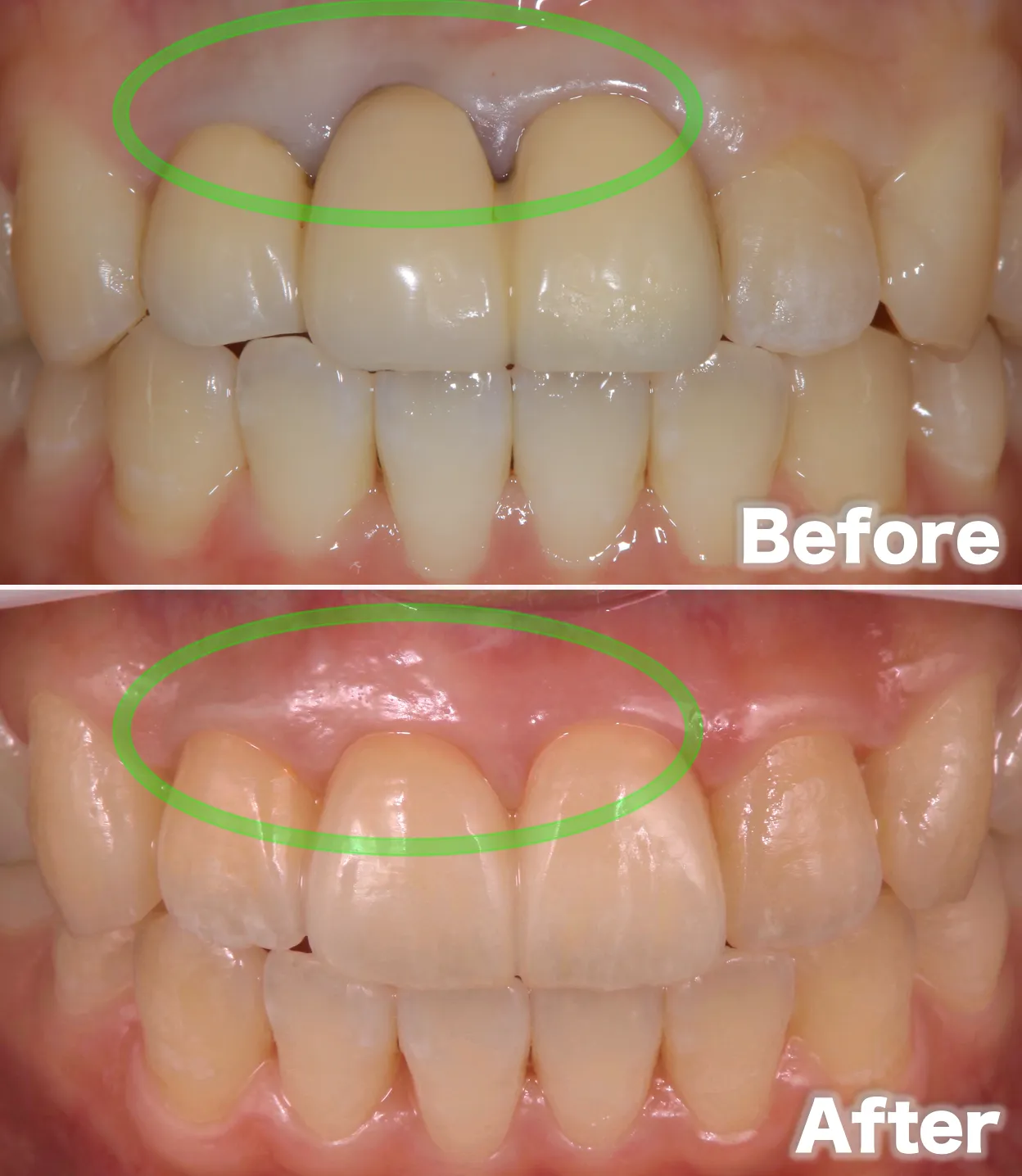 歯周病before after