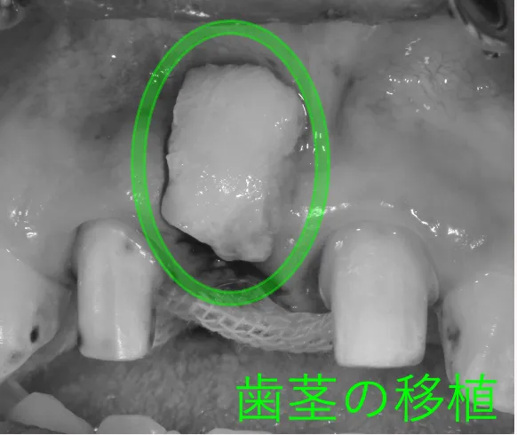 歯周病の治療法