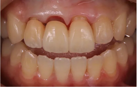 歯周病の治療法