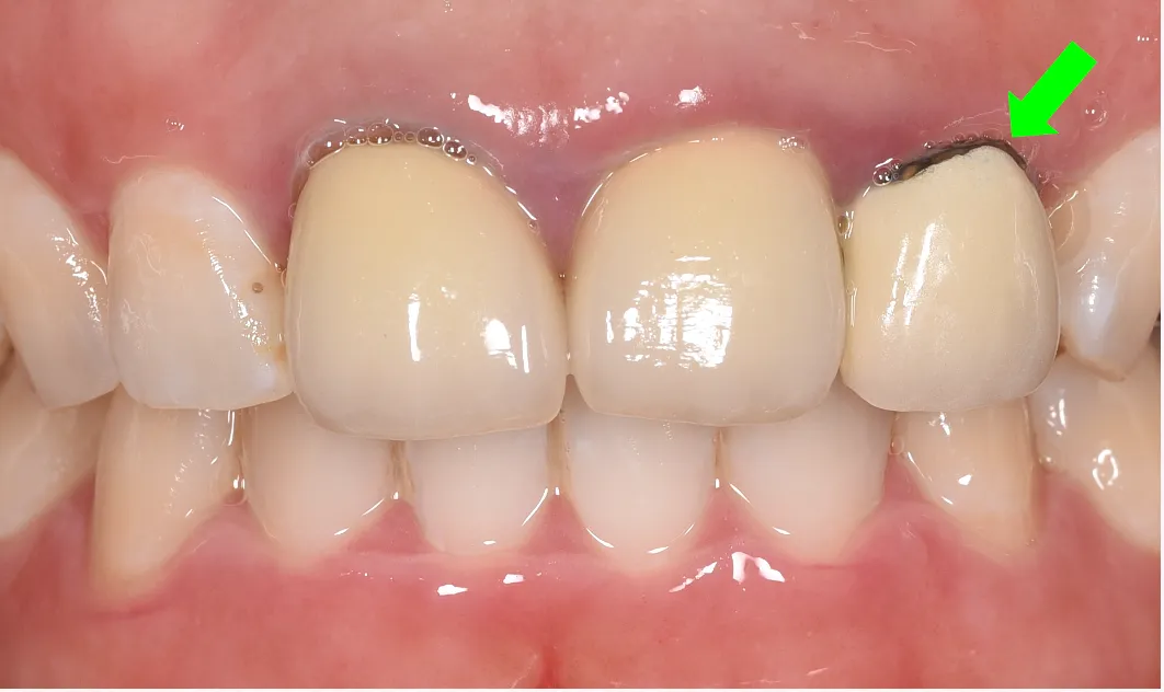 ③メタルマージン