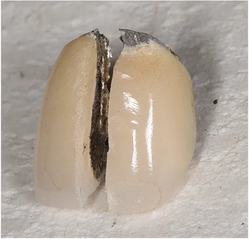 撤去した被せ物(メタルボンド)