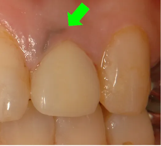 メタルタトゥーの原因