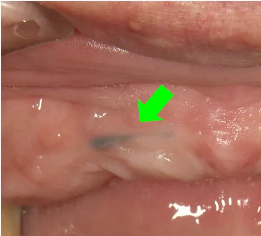 メタルタトゥーの原因