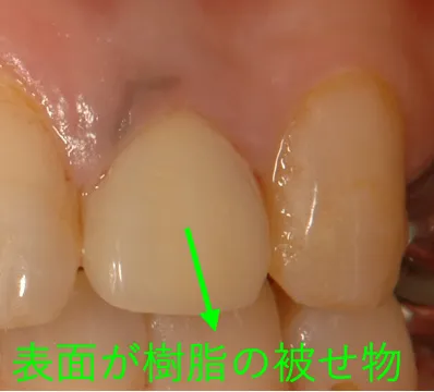 表面は白い樹脂でコーティングされていますが、被せ物のフレームには非貴金属が使用されている。