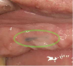 そして歯を抜いた後でもメタルタトゥーは消えることはありません。