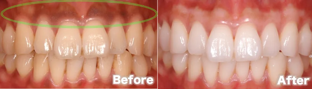 ⑤メラニン色素before after