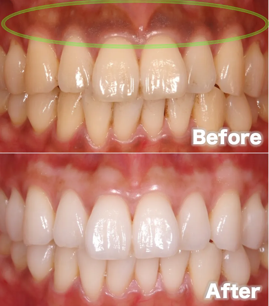 ⑤メラニン色素before after