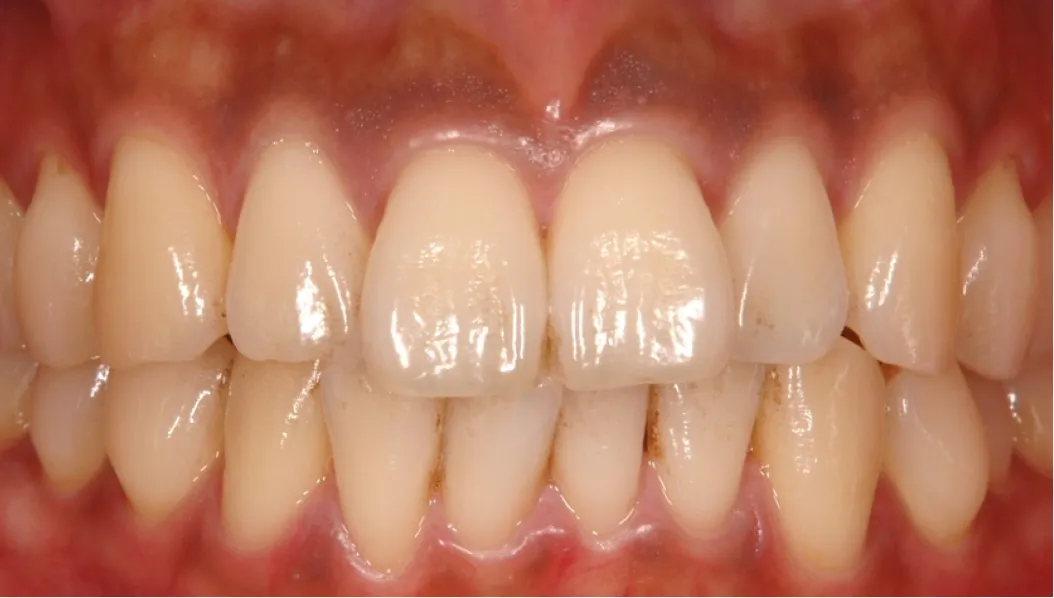 メラニン色素の原因