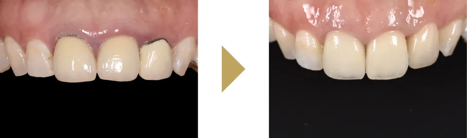 歯茎が黒いセラミッククラウンをやり直した症例