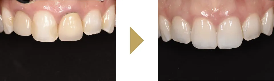 変色した差し歯をジルコニアセラミックで治療した症例