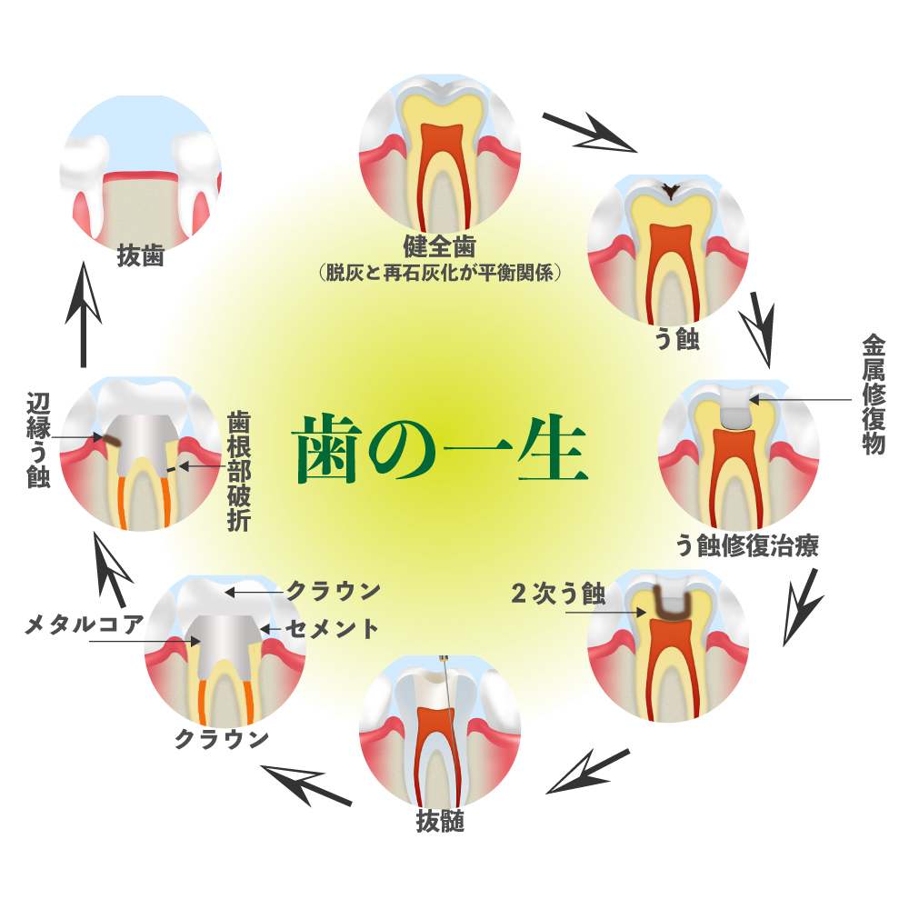 歯の治療限界回数