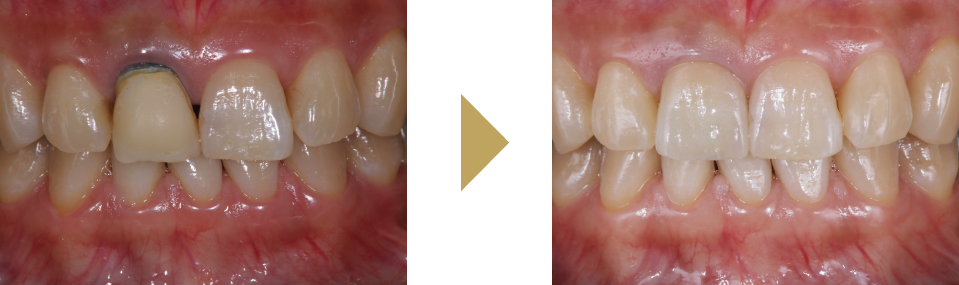 右上前歯をセラミッククラウンで治療した症例