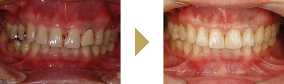 ダイレクトボンディングとセラミッククラウンを併用した治療した症例