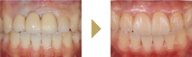 前歯3本をセラミックのブリッジで治療した症例
