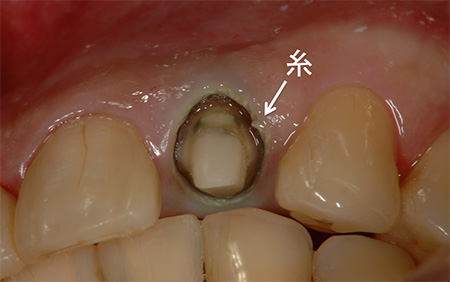 歯の縁を鮮明に型取りする一工夫