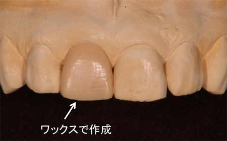 診断用ワックスアップ(シミュレーション)