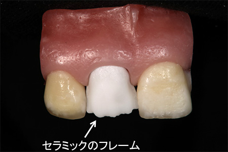 擬似模型にセラミックのフレームを合わせた写真