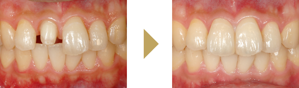 右上前歯のクラウン（差し歯）のやり変えた症例