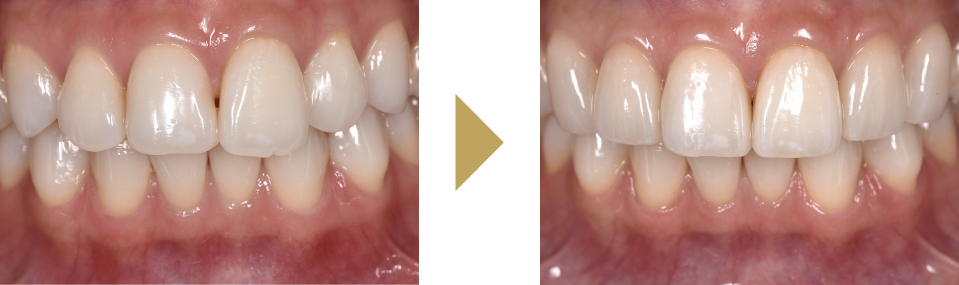 尖っている前歯をラミネートベニア(セラミック)で治療した症例