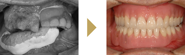 最小限の本数のインプラントを使用した入れ歯治療の症例