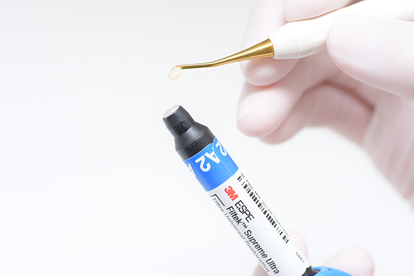 ダイレクトボンディングの特徴