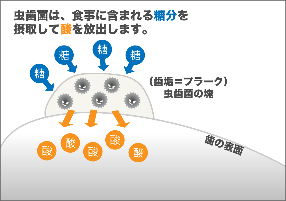 虫歯の原因