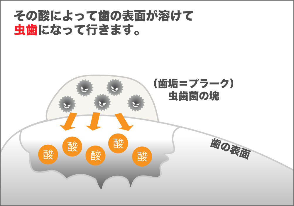 虫歯の原因