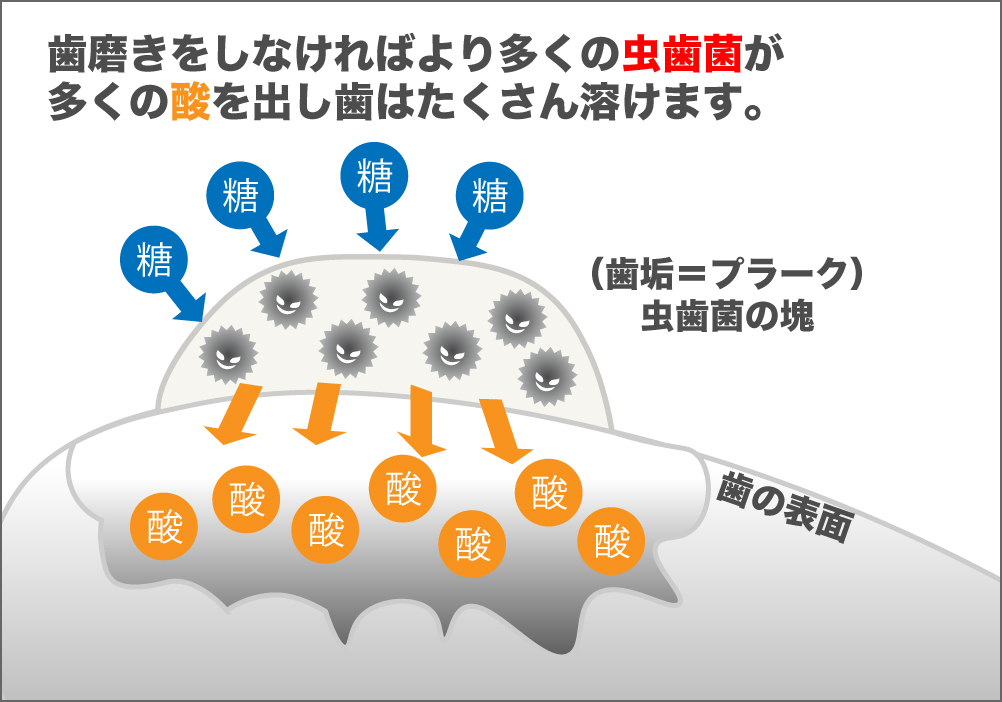 虫歯にならないためには