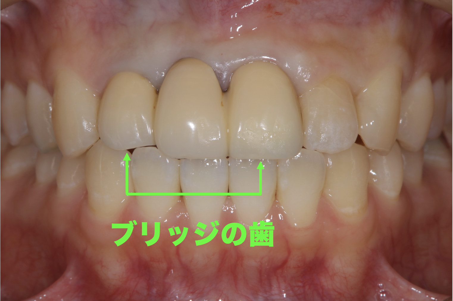 症例:歯茎が萎縮してしまい審美性が低い歯