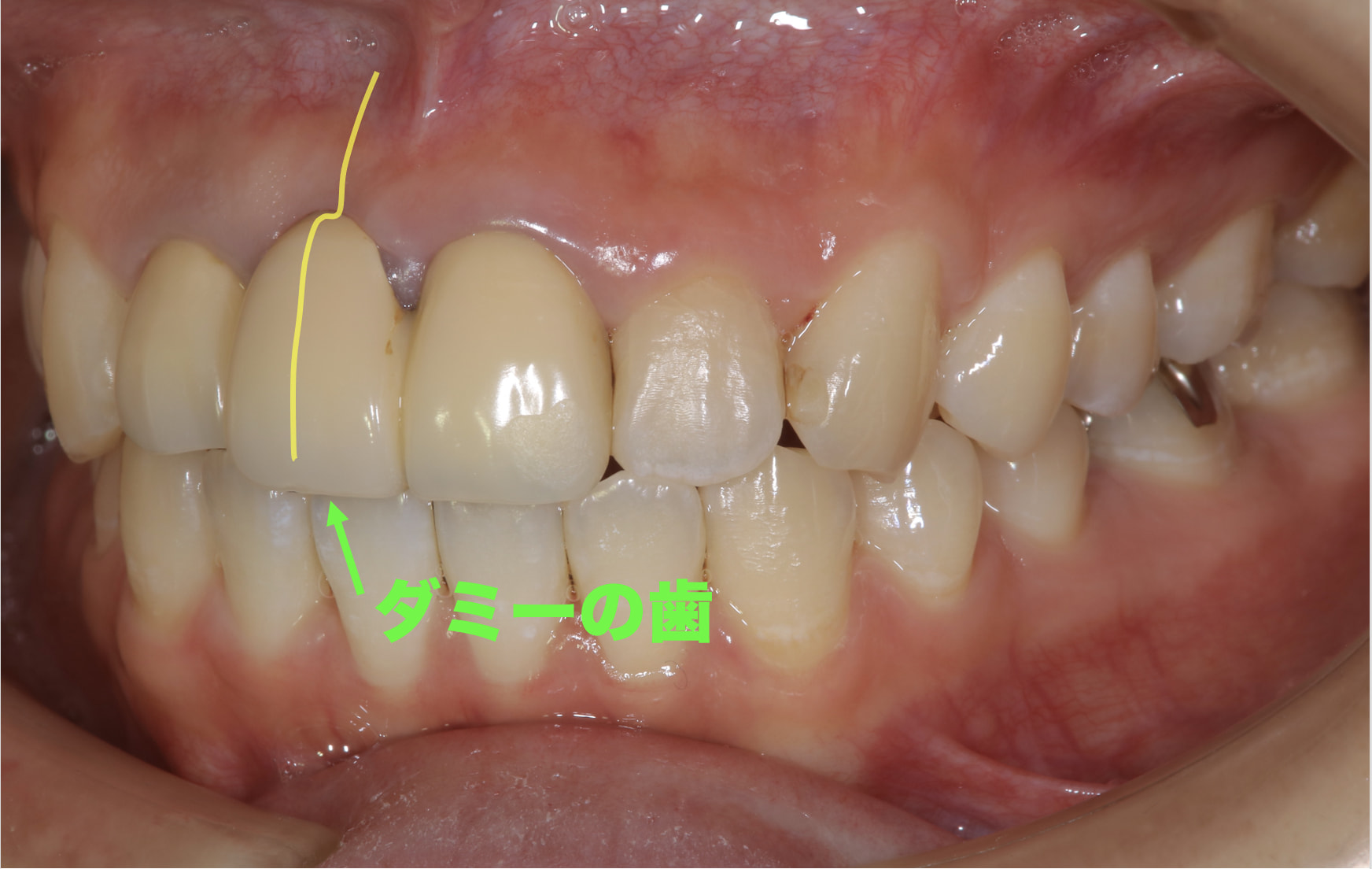 症例：歯茎が凹んでしまって段差になってしまっている