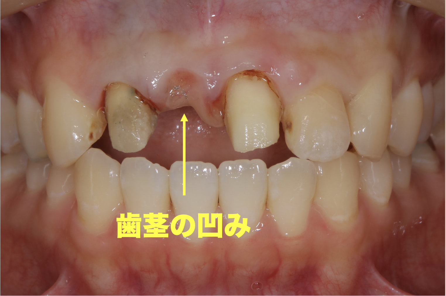 症例:凹んだ歯茎からブリッジを除去した写真。歯茎が萎縮して痩せているのがよりよくわかる