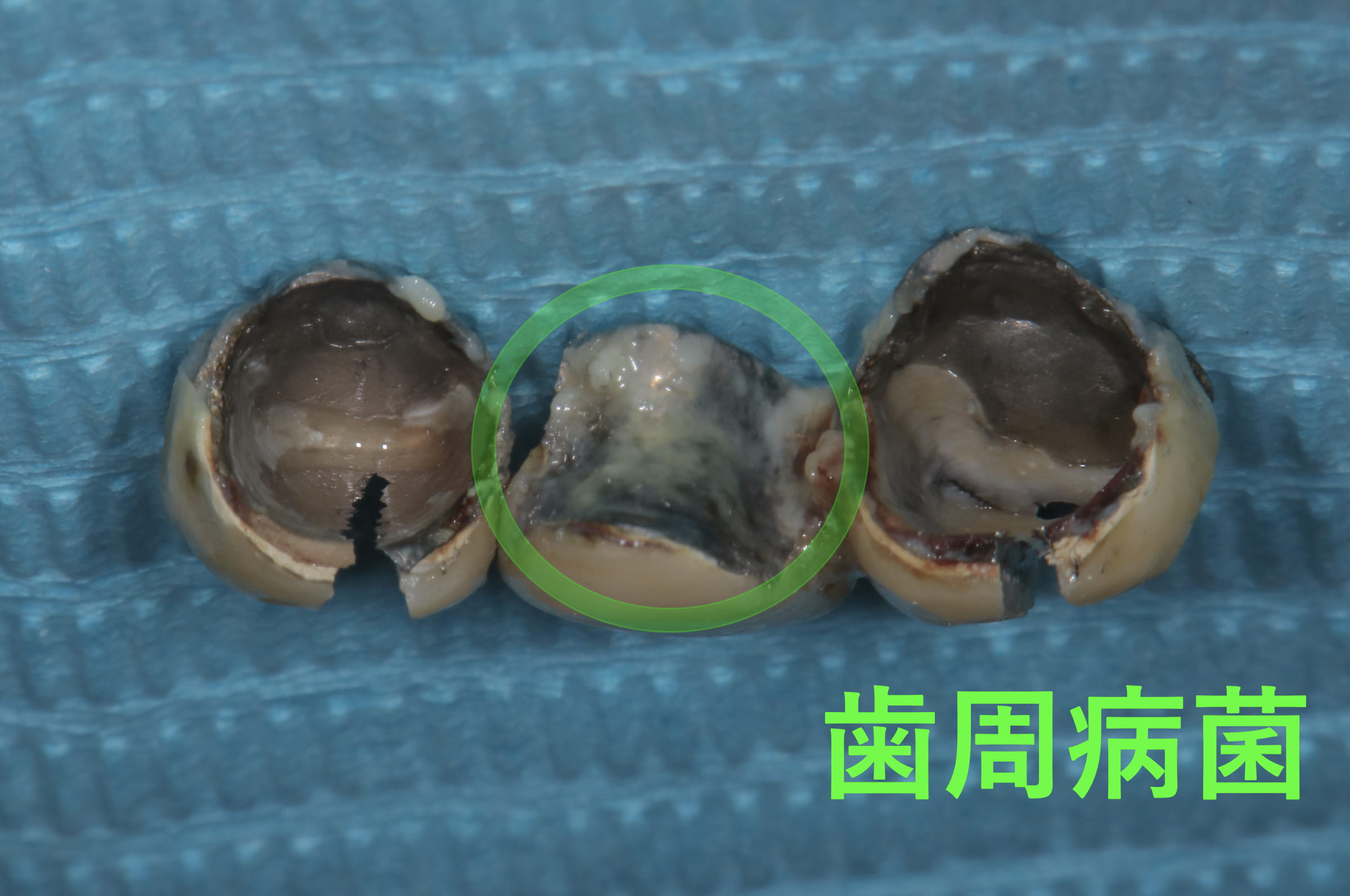 症例:除去したブリッジの内側。痩せた歯茎の隙間から汚れが入り、大量の歯周病菌が付着している。
