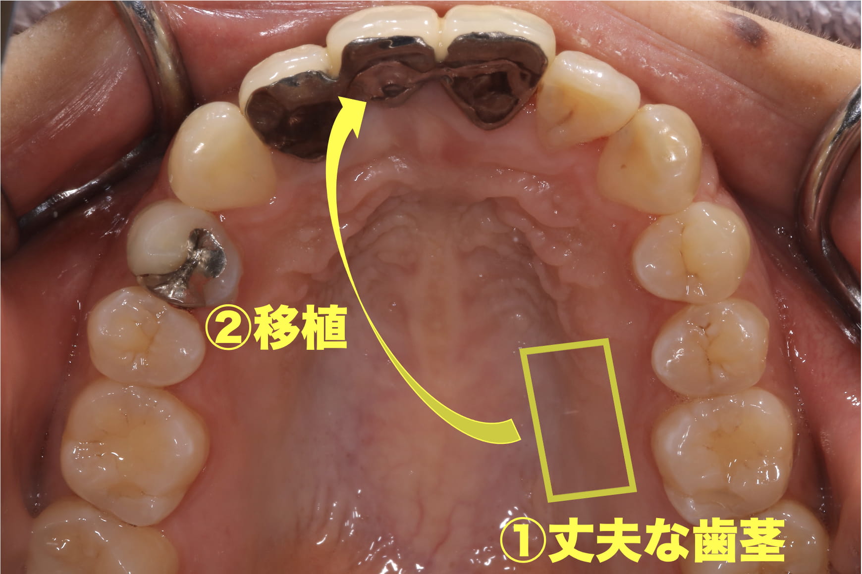 症例:健康で丈夫な歯茎と組織を移植する痩せて凹んだ歯茎の箇所の症例写真