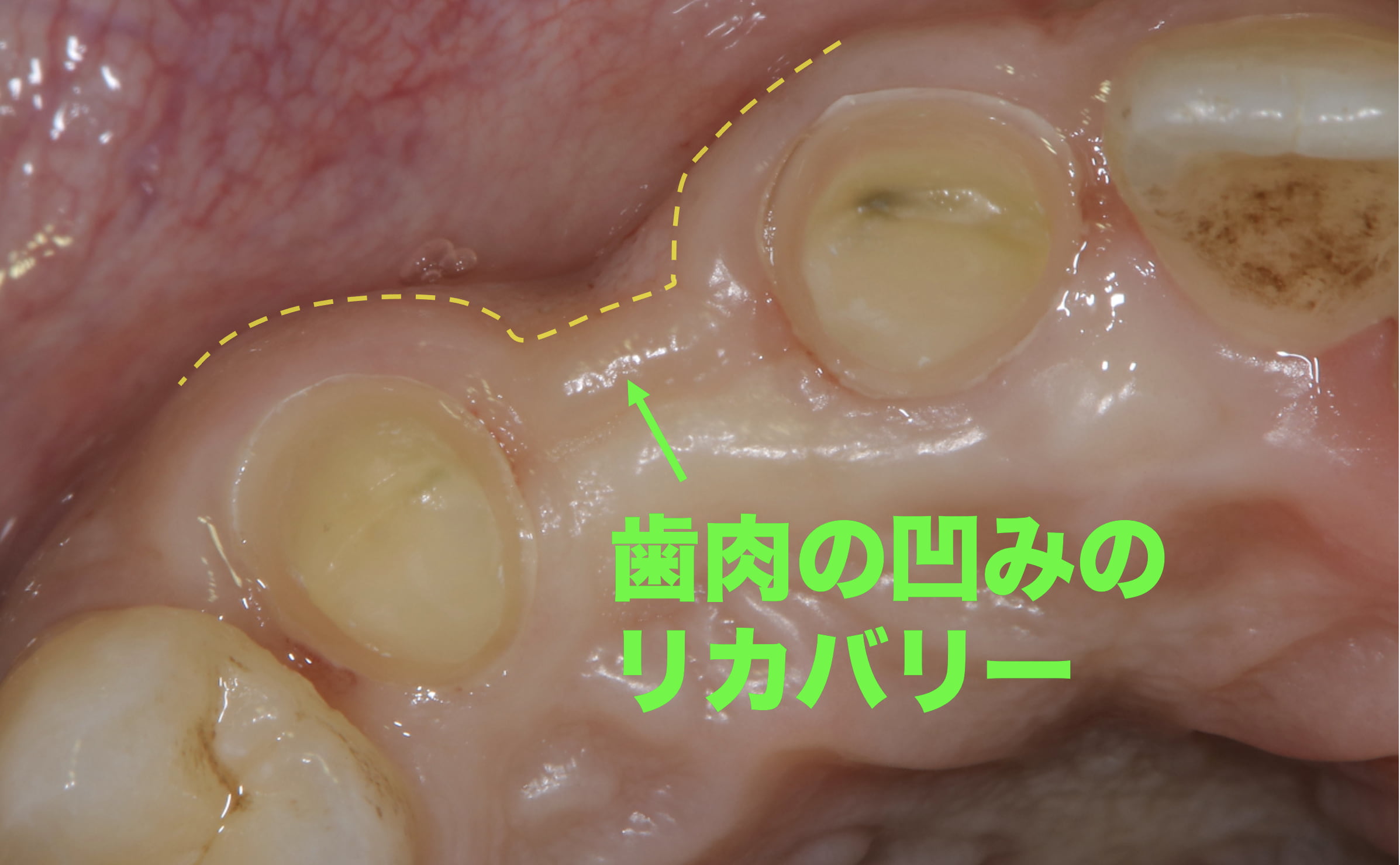 抜歯によって歯茎が大きく凹んでしまった状態の症例写真