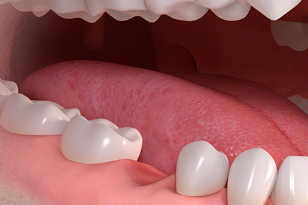 歯が抜けた後の治療法