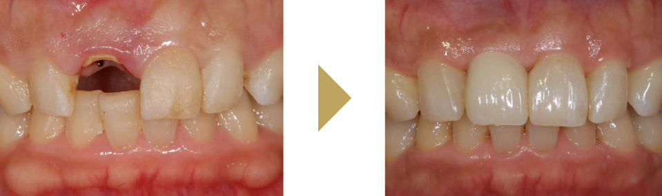 上顎にインプラント(1本)を埋入した症例