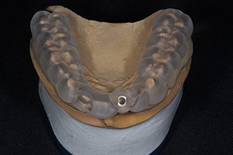 高精度CTとインプラントシミュレーションを用いた精密なインプラント治療