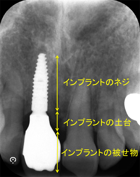 インプラントの長持ちにこだわります