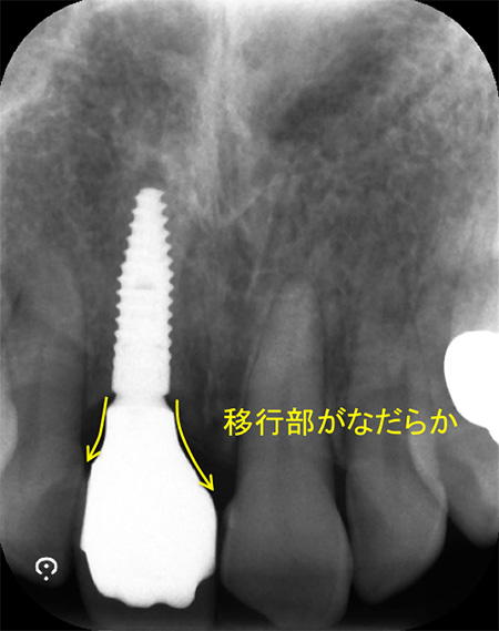 インプラントの長持ちにこだわります