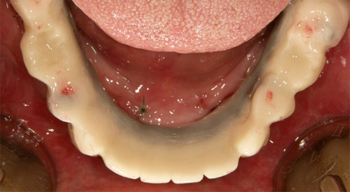 インプラント埋入当日の仮歯