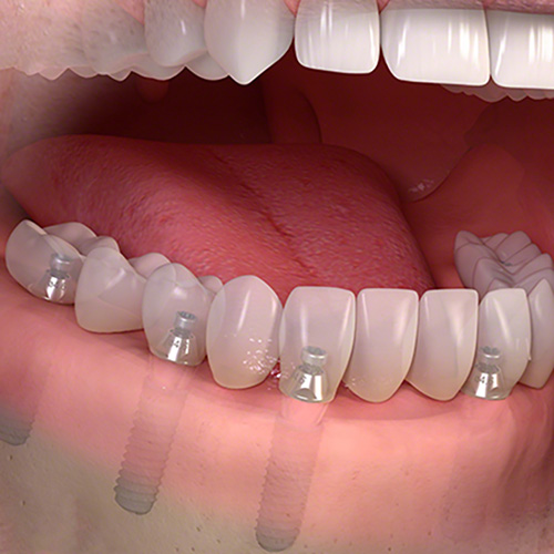 〜All-On-4,All-On-6〜