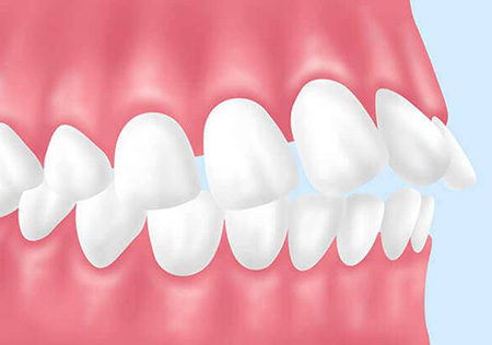 上顎前突(出っ歯)