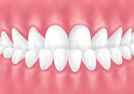 下顎前突(受け口)