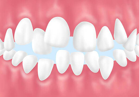 叢生(乱ぐい歯)