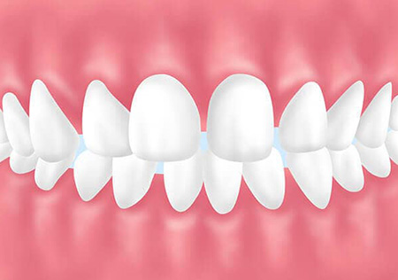 空隙歯列(すきっ歯)