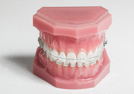 ワイヤー矯正の特徴